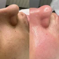 فشیال/کربوکسی تراپی صورت