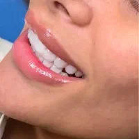 کامپوزیت دندان روش لیرینگ با ضمانت|خدمات آرایشگری و زیبایی|مشهد, فلسطین|دیوار