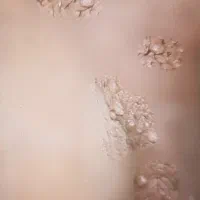 پاکسازی زگیل و تبخال