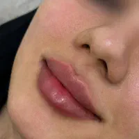 مناسبت افتتاحیه اف ۵۰ درصدی ژل و بوتاکس پیرسینگ