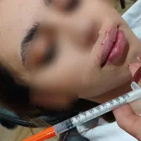 انجام خدمات ژل و بوتاکس|خدمات آرایشگری و زیبایی|اسلامشهر, شهرک مصطفی خمینی|دیوار