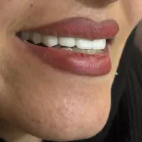 دندان پزشکی کامپوزیت عصب کشی روکش