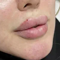 ژل وبوتاکس انواع مزوژل