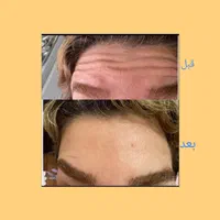 جشنواره تزریق ژل و بوتاکس وانزیم|خدمات آرایشگری و زیبایی|ملارد, |دیوار