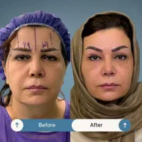 جراحی صورت ۵۰درصد تخفیف|خدمات آرایشگری و زیبایی|تهران, دروس|دیوار
