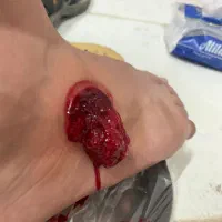 حجامت اسلامی بادکش گرم فصد سیاتیک دیسک