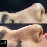 تزریق ژل و بوتاکس با بروزترین تکنیک ها|خدمات آرایشگری و زیبایی|ارومیه, |دیوار