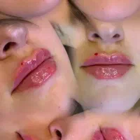 تزریق ژل فیلر بوتاکس ویژه