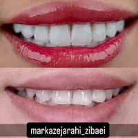 ایمپلنت کامپوزیت لمینت بلیچینگ عصب کشی ارتو|خدمات آرایشگری و زیبایی|مشهد, سجاد شهر|دیوار
