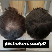 میکرو اسکالپ مکمل کاشت مو