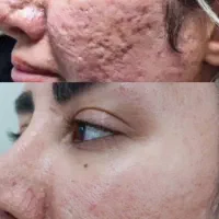 لیزر موفیشال لاغری پوست فیلر بوتاکس ویژه بانوان|خدمات آرایشگری و زیبایی|خمینی‌شهر, |دیوار