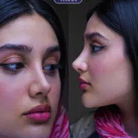 سپتو رینو با تیم حرفه ای لیپوساکشن