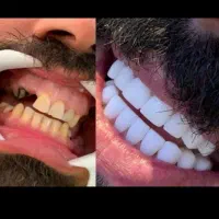 آموزش تخصصی کامپوزیت دندان با برد تخصصی|خدمات آموزشی|اندیشه, شهرک کوثر|دیوار