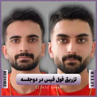 تخفیفات ۵۵٪ دکتر ملائی ،مزو بوتاکس فیلر ژل لب روسی|خدمات آرایشگری و زیبایی|مشهد, کوثر|دیوار