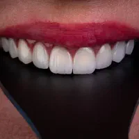 کامپوزیت دندان سارمکو کاریزما آی پی اس الترادنت|خدمات زیبایی و سلامت|تهران, نارمک جنوبی|دیوار