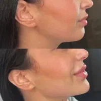 بوتاکس ژل لب خط خنده چانه گونه|خدمات آرایشگری و زیبایی|گرگان, |دیوار