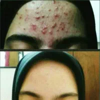 درمان جوش با محصولات مراقبتی پوست