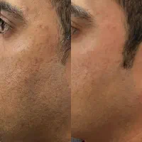 آموزش ژل بوتاکس مزو وساب سیژن ‌لیزر