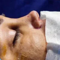 جراحی بینی عمل بینی انواع جراحی زیبایی|خدمات آرایشگری و زیبایی|ساری, |دیوار