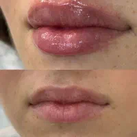 تزریق ژل و بوتاکس|خدمات آرایشگری و زیبایی|قم, صدوق|دیوار