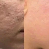 درمان ریشه‌ای جوش و جای جوش