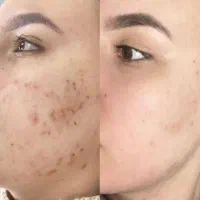 مشکلات پوستیی پسوریازیس لک و...تضمینی|آرایشی، بهداشتی، درمانی|اردبیل, |دیوار