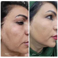 خدمات و آموزش تخصصی ژل و بوتاکس|خدمات آرایشگری و زیبایی|کرج, کیانمهر|دیوار