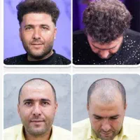 جشنواره پاییزی کاشت مو