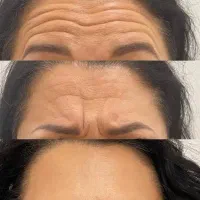 خدمات تزریق ژل بوتاکس مزو و پیرسینگ