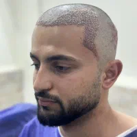 کاشت مو و ابرو|خدمات آرایشگری و زیبایی|جوانرود, |دیوار