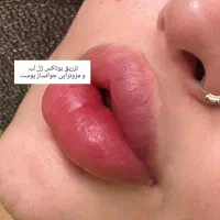 مدل برای تزریق بوتاکس و مزوتراپی جوانساززیرنظرپزشک