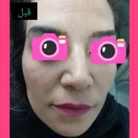 مزو میکرو نیدلینگ ،جوانسازی