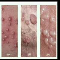 بهبود و کنترل زگیل تناسلی با مکملات کاملن گیاهی|آرایشی، بهداشتی، درمانی|گرگان, |دیوار