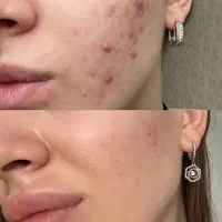 آموزش تخصصی فیشال و پاکسازی پوست از صفر تا حرفهای