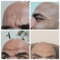مدل بوتاکس ژل مزوتراپی میکرونیدلینگ فشیال|خدمات آرایشگری و زیبایی|فردیس, طالقانی|دیوار