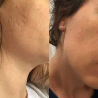 افرتابستانه از بین بردن تخصص جای جوش و اسکار پوستی|خدمات آرایشگری و زیبایی|شیراز, باهنر|دیوار