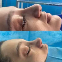 30درصد تخفیف عمل بینی و پیکرتراشی فوق تخصص پلاستیک|خدمات آرایشگری و زیبایی|تهران, محمودیه|دیوار