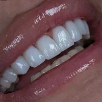 دندانپزشکی زیبایی  پالیش ایمپلنت عصب کشی جرم گیری