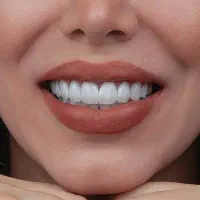 کامپوزیت دندان لمینت روکش طلا اقساط|خدمات آرایشگری و زیبایی|تهران, دریاچه شهدای خلیج فارس|دیوار
