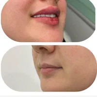 تزریق فیلر ژل بوتاکس