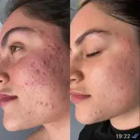 مدل رایگان برای پوست جوش دار و اسکار و لک|خدمات آرایشگری و زیبایی|رشت, گلباغ نماز|دیوار