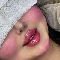 تزریق چربی ، تزریق ژل ، تزریق بوتاکس در مطب