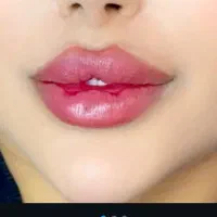 تزریق و آموزش ژل و بوتاکس مزو پی آر پی نخ و میکرو|خدمات آرایشگری و زیبایی|شیراز, ملاصدرا|دیوار