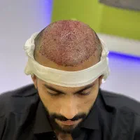جشنواره  تخفیفی کاشت مو ابرو و مژه|خدمات آرایشگری و زیبایی|قم, سالاریه|دیوار