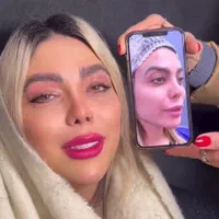 بلفاروپلاستی پلک وسانترال لب 9.360