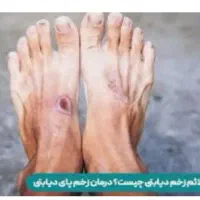 بهبود کامل دیابت به روش های کاملاً گیاهی وتضمینی