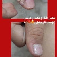 درمان ریشه ای زگیل و تبخال به صورت گیاهی|آرایشی، بهداشتی، درمانی|ساری, |دیوار