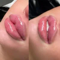 ژل لب، فیلر صورت، بوتاکس|خدمات آرایشگری و زیبایی|نجفآباد, امام خمینی|دیوار