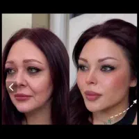 ژل از ۱۵۰۰کشیدن پوست لیفت شقیقه بانخ زیر چشم بینی