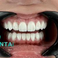 لمینت‌ IPS e.max شرایط اقساط ویژه